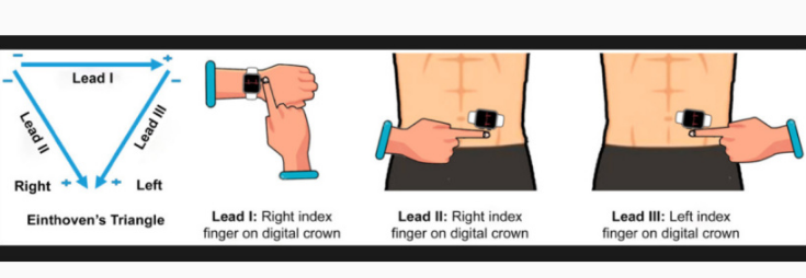 研究表明苹果 Apple Watch 具有潜在检测心脏病发作的能力